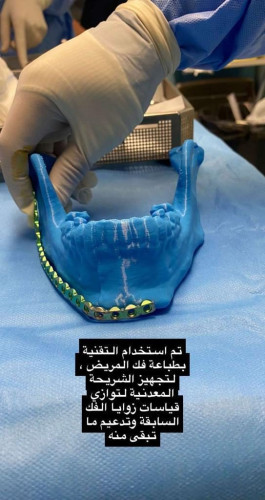 إعادة بناء فك مريض بتبوك