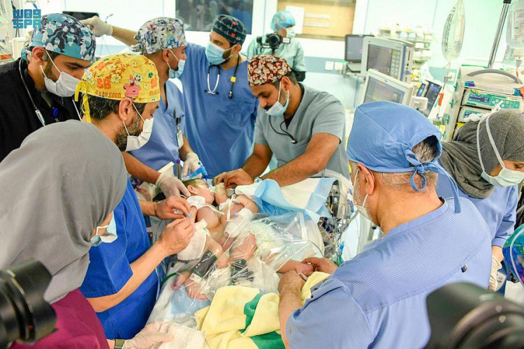 بدء عملية فصل التوأم السيامي العراقي “على وعمر