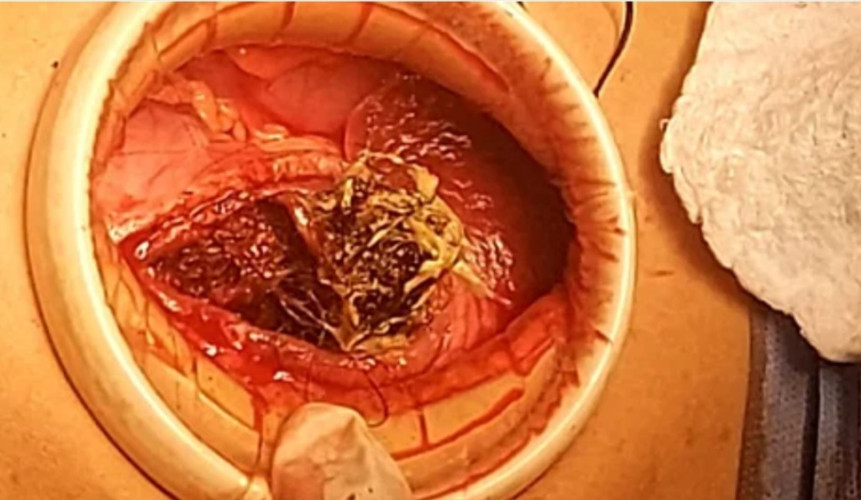 في عملية نادرة..استخراج كتلة شعر كبيرة من معدة امرأة في مستشفى الملك عبدالعزيز بمكة