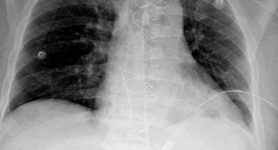 استرواح ونقل عاجل للعمليات.. “سعود الطبية” تنقذ مقيمًا تعرض لإصابة نافذة في القلب