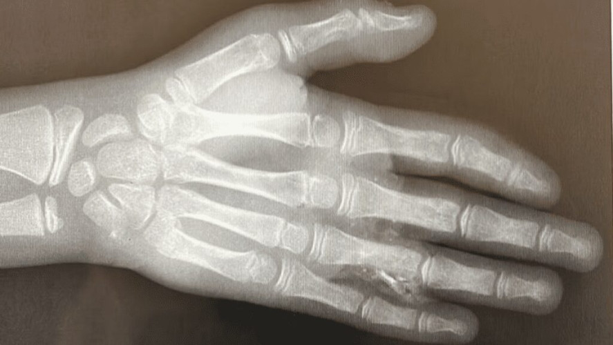 جراحة طارئة تنقذ طفلًا تعرّض لحادث مروري في الحريق