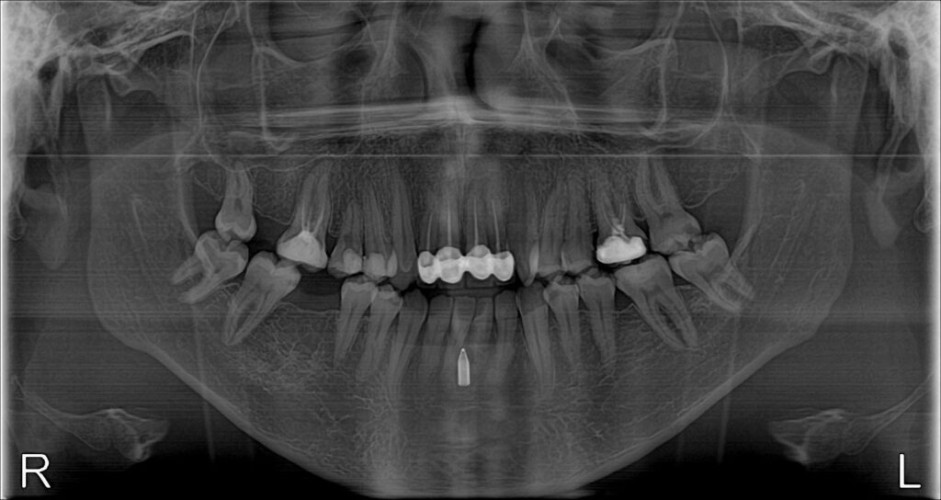 جراحة ٣٠ دقيقة تنهي معاناة مريض دامت ١٣ عام