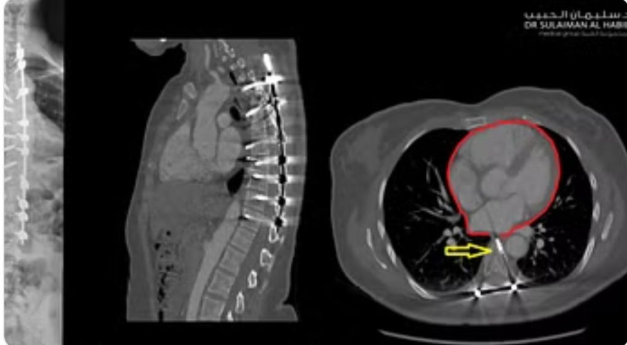 مستشفى سليمان الحبيب بالريان ينقذ ثلاثينية من مضاعفات جراحة سابقة بالعمود الفقري