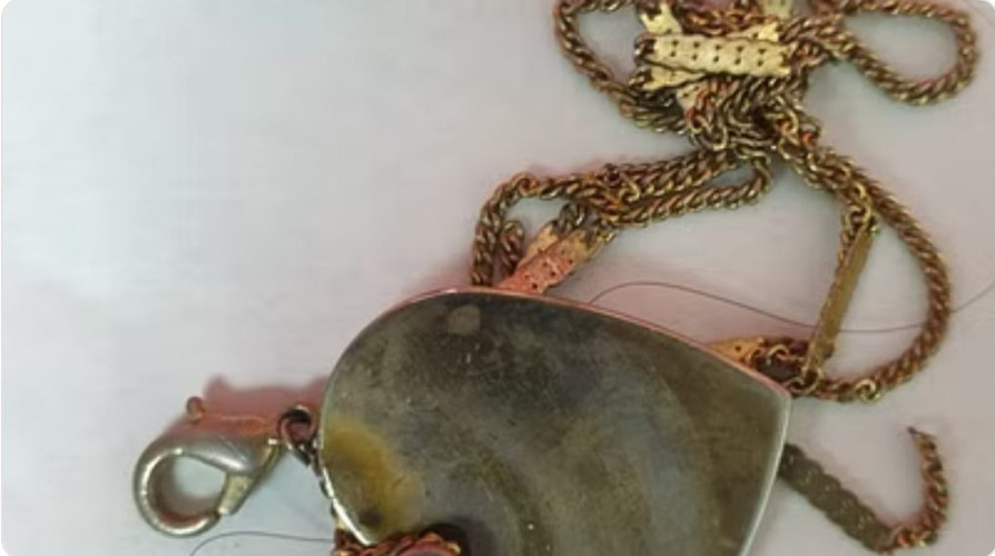 استقرت بالمريء.. تدخل طبي طارئ بالمدينة ينقذ حياة طفلة ابتلعت “قلادة”!