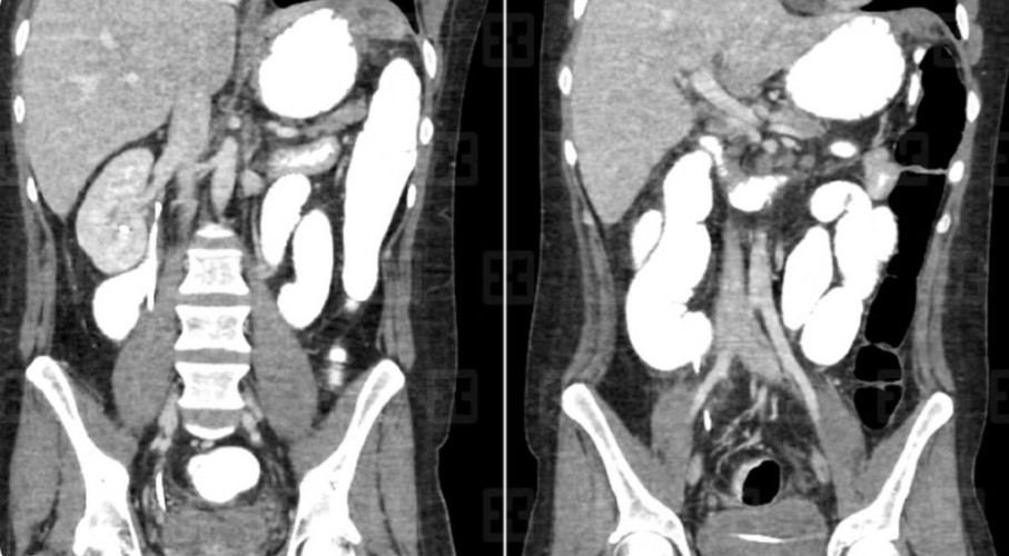 مستشفى سليمان الحبيب بالخُبر ينجح في استئصال ورم بطني وزنه 3 كجم
