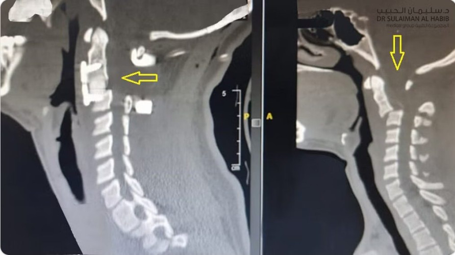 مستشفى الدكتور سليمان الحبيب بالقصيم ينقذ طفلة من الشلل نتيجة حادث مروع تسبب بكسر تشابكي عكسي بالرقبة