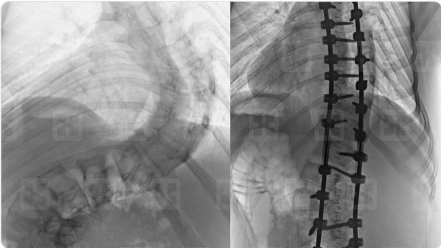 مستشفى سليمان الحبيب بالقصيم: فريق طبي يُجري 4 عمليات تعديل جنف ناجحة خلال 48 ساعة