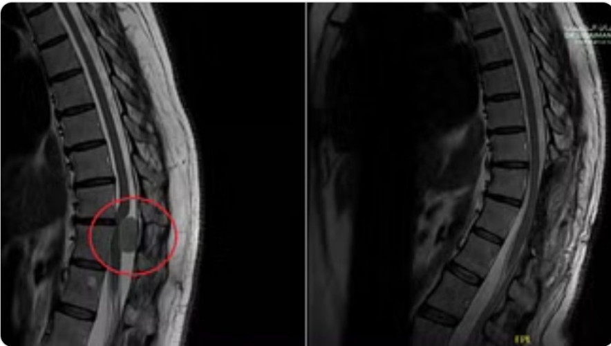 مركز جراحات المخ والأعصاب والعمود الفقري بمجمع الدكتور سليمان الحبيب بالعُليا يُعيد قدرة خمسينية على المشي مجدّداً