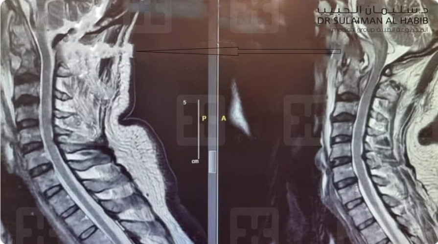 جراحة نادرة ومعقدة بمستشفى سليمان الحبيب بالقصيم تعيد الحركة لستيني عانى من شلل نصفي