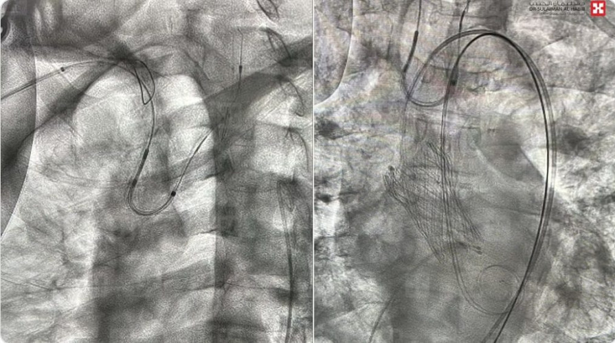 مستشفى الدكتور سليمان الحبيب بالتخصُّصي ينهي معاناة تسعيني مع تضيق في الصمام الأبهر