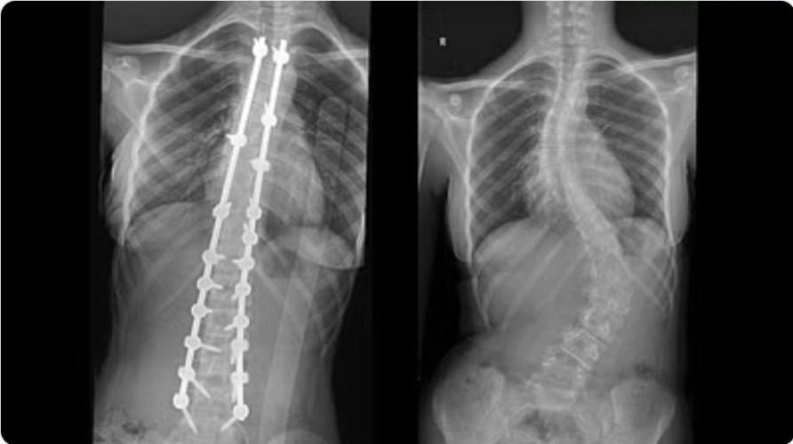 جراحة ناجحة “لفتاة” بمجمع الدكتور سليمان الحبيب بالعليا لتصحيح تقوّسات حادّة بالفقرات القطنية والصدرية وعظام الحوض