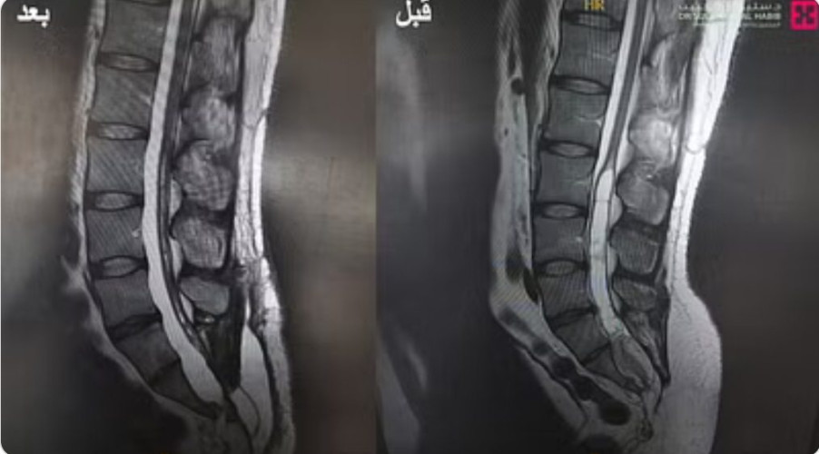 إنهاء معاناة شاب مع عيب خلقي وورم كبير مخترق للقناة الشوكية