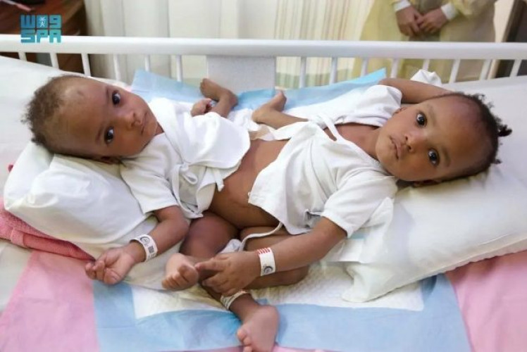 إنفاذًا لتوجيهات خادم الحرمين الشريفين .. بدء عملية فصل التوأم السيامي النيجيري”حسانة وحسينة”