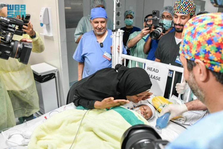 نجاح فصل التوأم السيامي التنزاني “حسن وحسين” بعد عملية جراحية معقدة استغرقت 16 ساعة