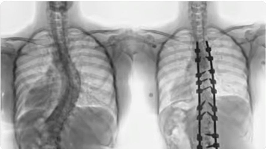 مستشفى الدكتور سليمان الحبيب بالقصيم ينهي معاناة “قطرية” مع انحراف بالعمود الفقري بجراحة معقدة