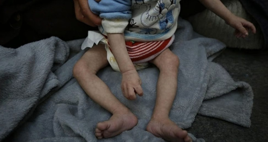 بينهم طفلان.. وفاة 4 فلسطينيين بسبب الجوع بمستشفى كمال عدوان في بيت لاهيا شمال غزة