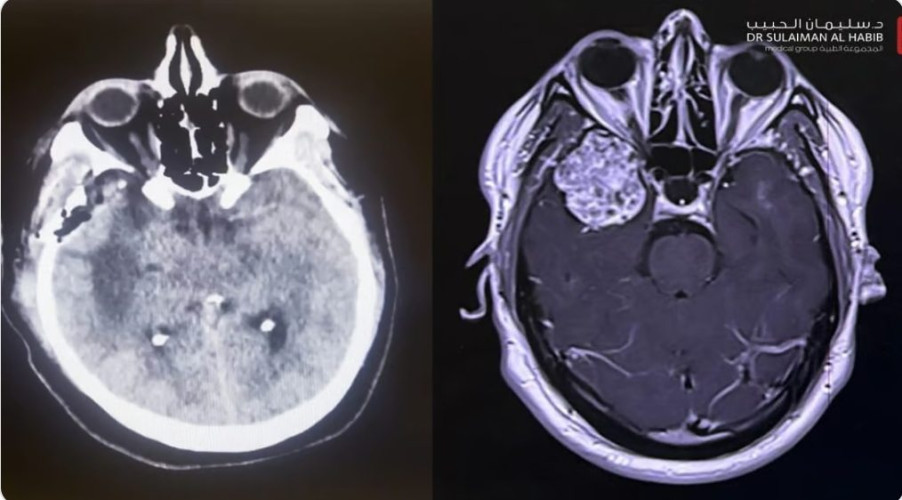 مستشفى الدكتور سليمان الحبيب بالخبر يستأصل ورماً دماغياً سبب فقدان الوعي وتشنجات حادة لخمسيني