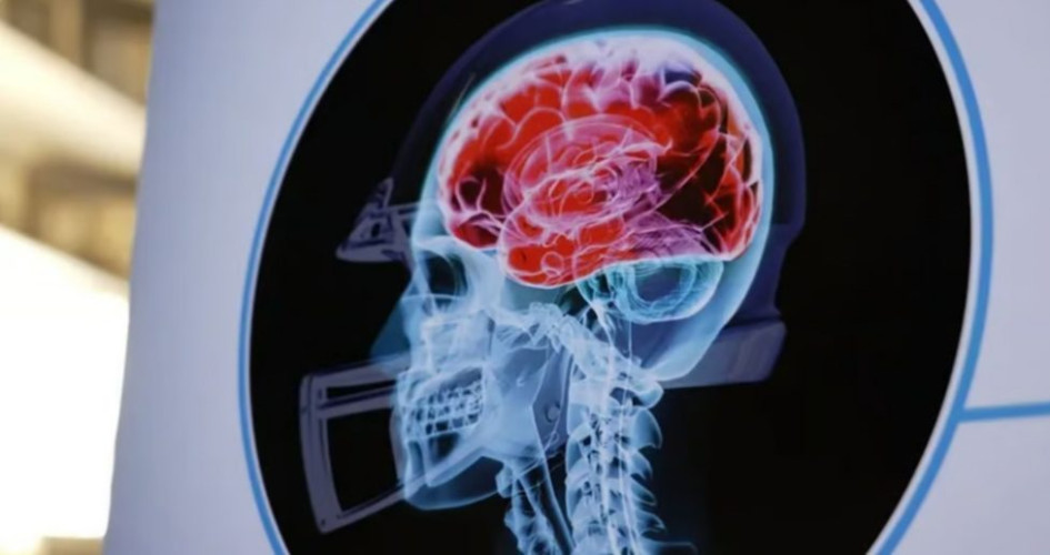 “دراسة”.. إصابات الرأس توقظ فيروسات الزهايمر