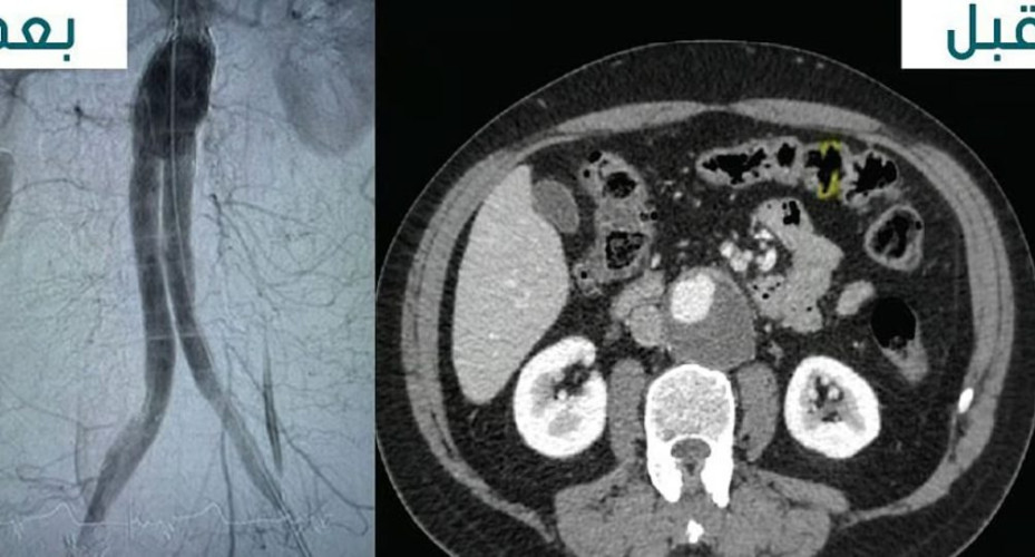 نجاح عملية إصلاح تمدد الشريان الأورطي البطني لمريض يبلغ من العمر 69 عامًا في مستشفيات المانع بالخبر