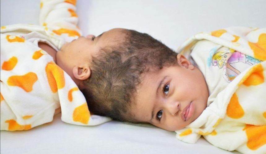 نجاح عملية فصل التوأم الملتصق الإريتري “أسماء وسمية” بعد عملية جراحية دقيقة استغرقت 15 ساعة ونصفًا