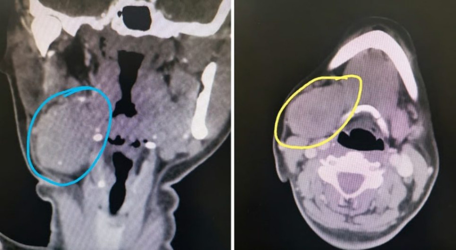 استغرقت ساعتين.. نجاح عملية دقيقة لاستئصال ورم من الغدة تحت الفك السفلي بمجمع الملك فيصل الطبي