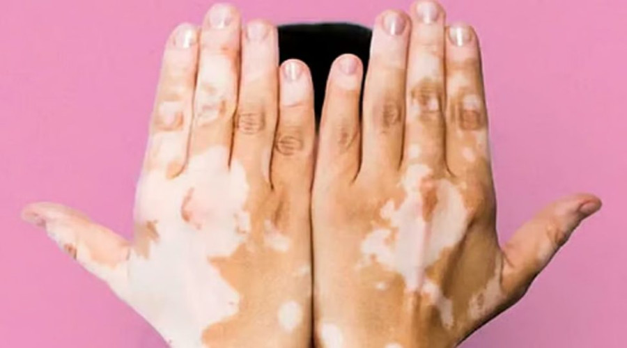 اليوم العالمي للبهاق.. توعية بالمرض وتفعيل الاستشارات الطبية وإمكانات العلاج