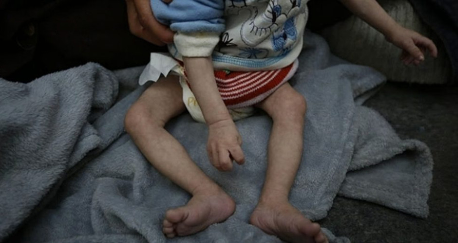 بينهم طفلان.. وفاة 4 فلسطينيين بسبب الجوع بمستشفى كمال عدوان في بيت لاهيا شمال غزة