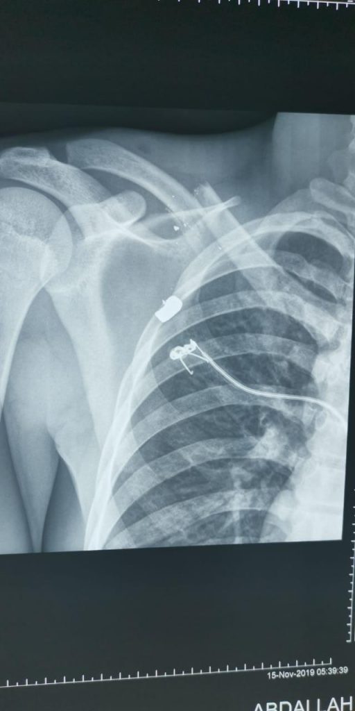 فريق طبي ينجح في تثبيت الترقوة جراحيا في مستشفى القويعية العام